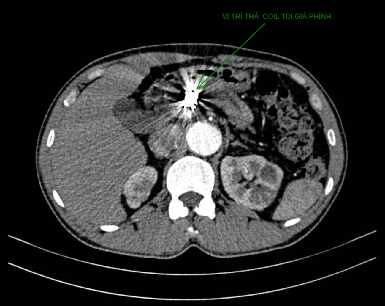 Hình CT sau thủ thuật đặt coil lấp đầy khối giả phình.jpg